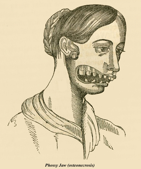 Occupational diseases Phossy jaw